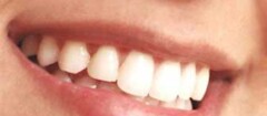 implantes-dentariosem-santa-cruz-do-sul-1444241585